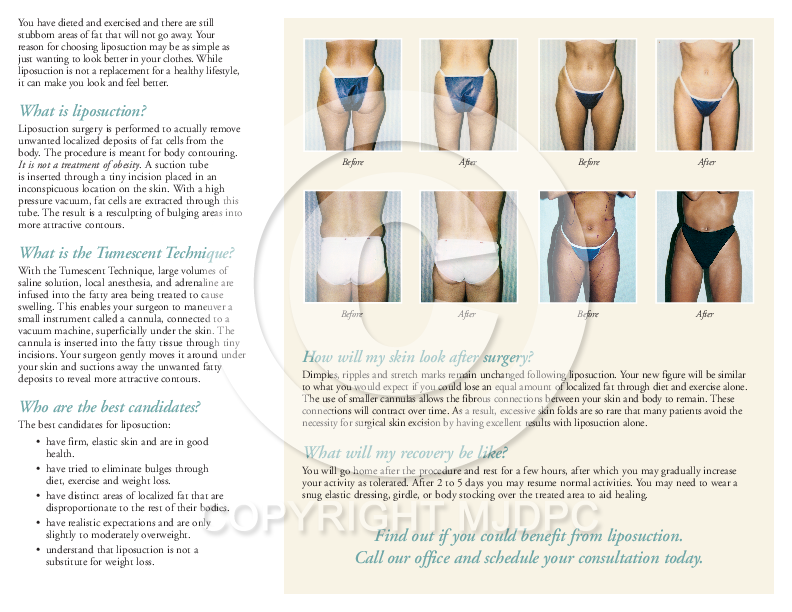 Liposuction for Body Sculpting Brochure: MJD Patient Communications